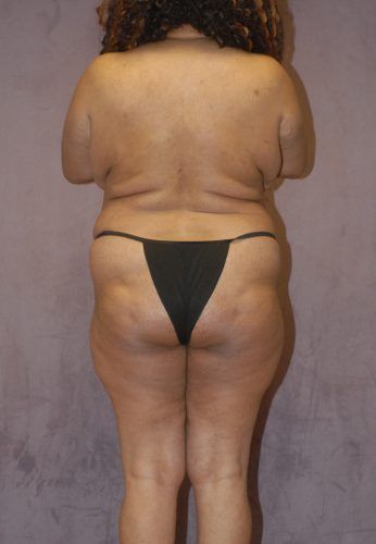 Liposuction Before & After