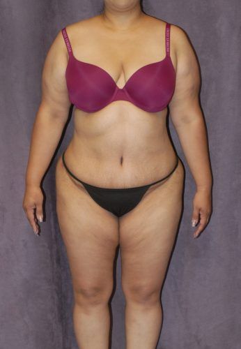 Liposuction Before & After