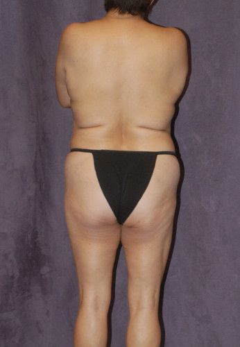 Liposuction Before & After