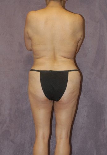 Liposuction Before & After