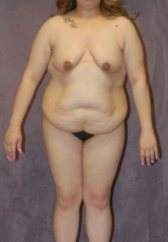 Liposuction Before & After