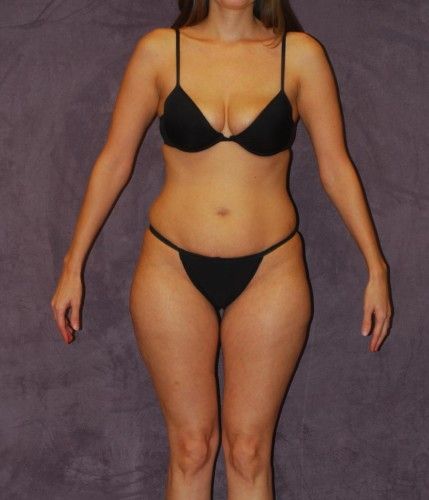 Liposuction Before & After