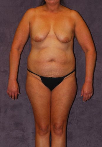 Liposuction Before & After