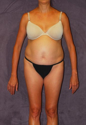 Liposuction Before & After