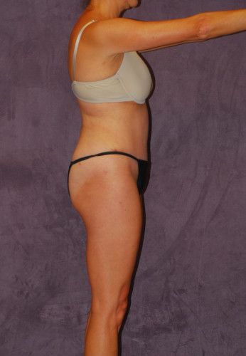 Liposuction Before & After