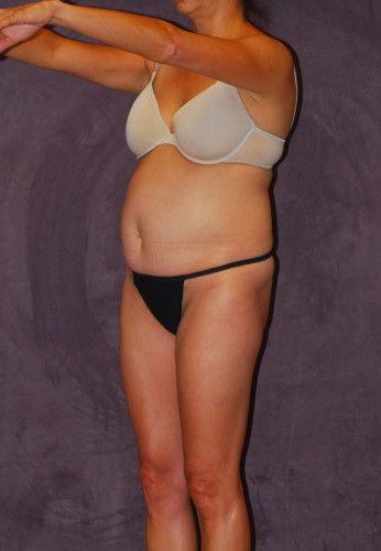 Liposuction Before & After