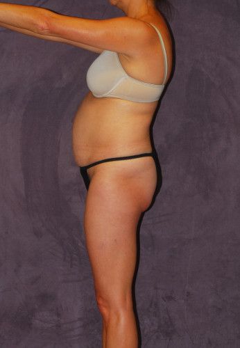 Liposuction Before & After