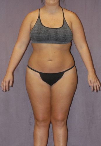 Liposuction Before & After