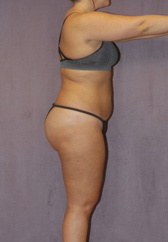 Liposuction Before & After