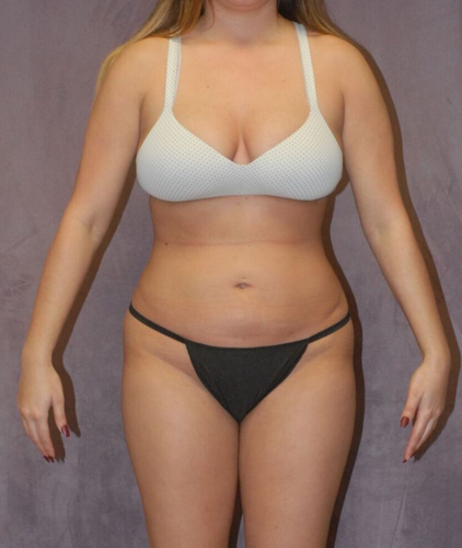 Liposuction Before & After