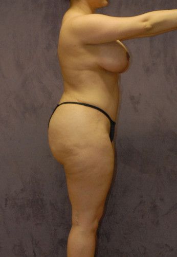 Liposuction Before & After