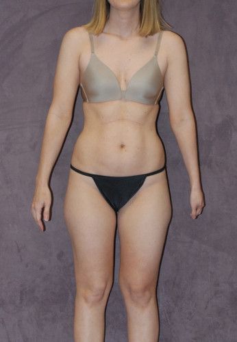 Liposuction Before & After