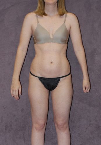 Liposuction Before & After