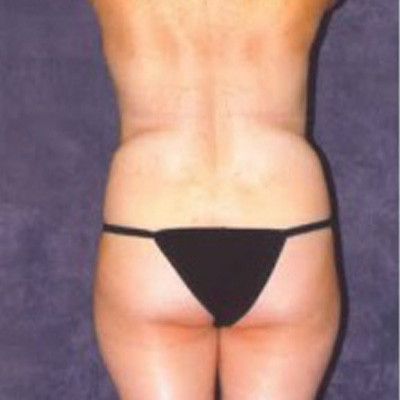 Liposuction Before & After