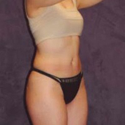 Liposuction Before & After