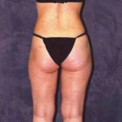 Liposuction Before & After