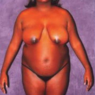 Liposuction Before & After