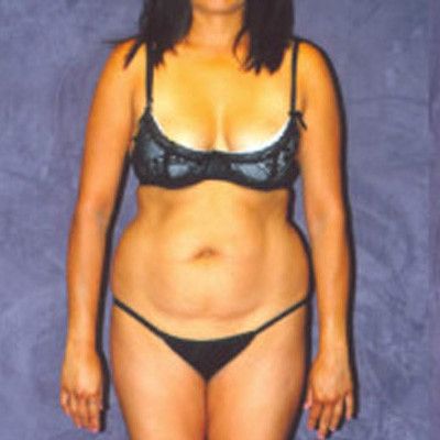 Liposuction Before & After
