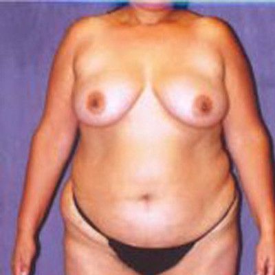 Liposuction Before & After