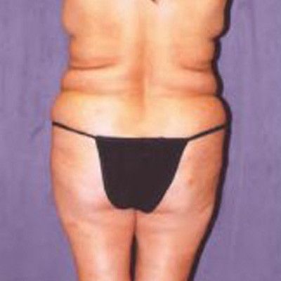 Liposuction Before & After