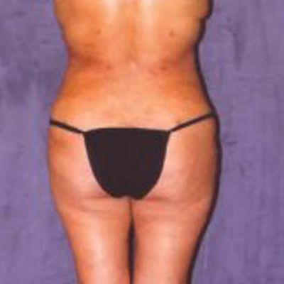 Liposuction Before & After