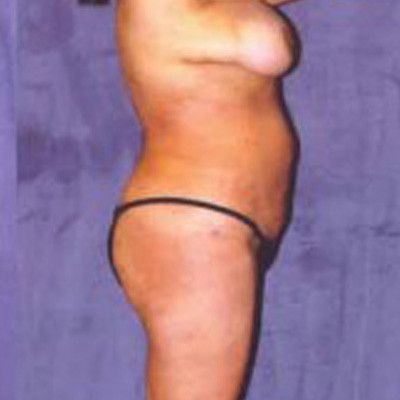 Liposuction Before & After