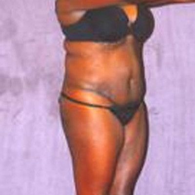 Liposuction Before & After