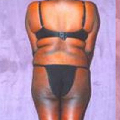 Liposuction Before & After