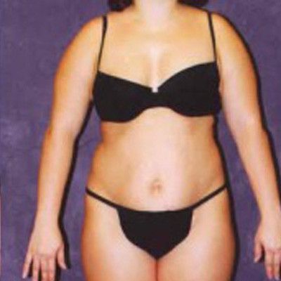 Liposuction Before & After