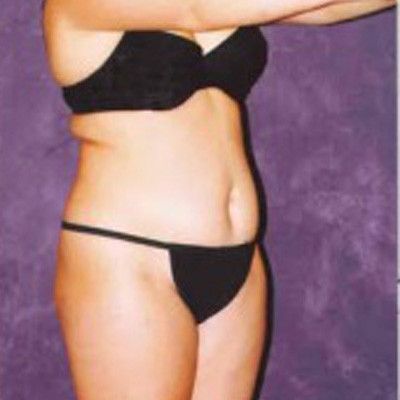 Liposuction Before & After