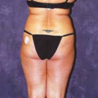 Liposuction Before & After
