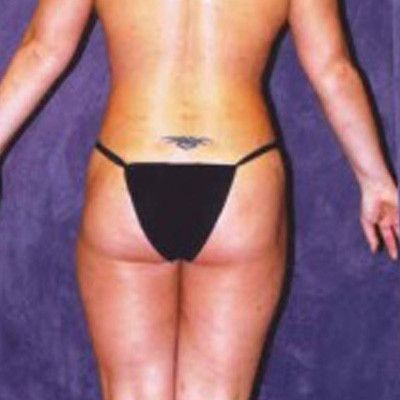 Liposuction Before & After