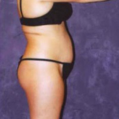 Liposuction Before & After