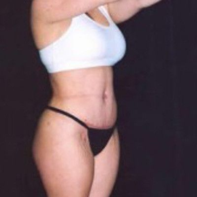 Liposuction Before & After