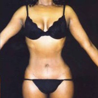 Liposuction Before & After