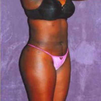 Liposuction Before & After