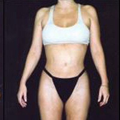 Liposuction Before & After