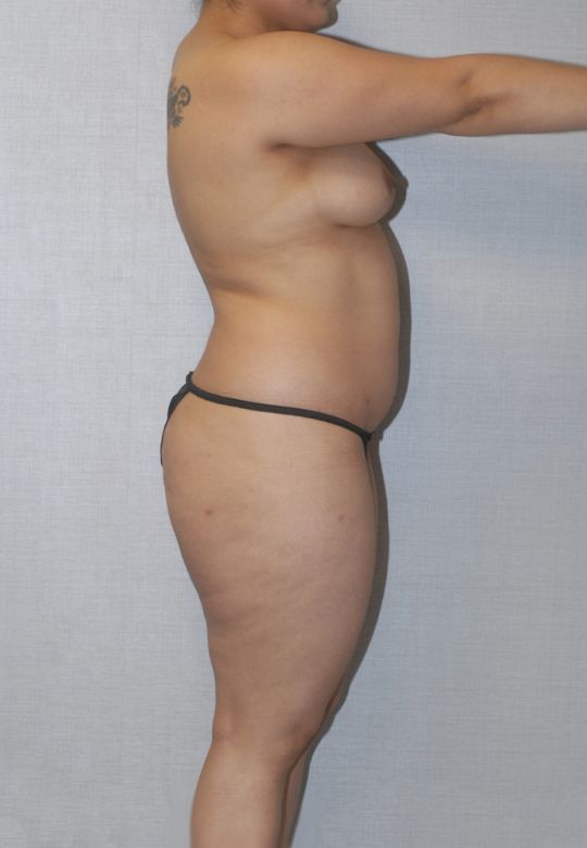 Liposuction Before & After