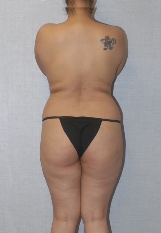 Liposuction Before & After