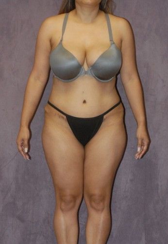 Liposuction Before & After