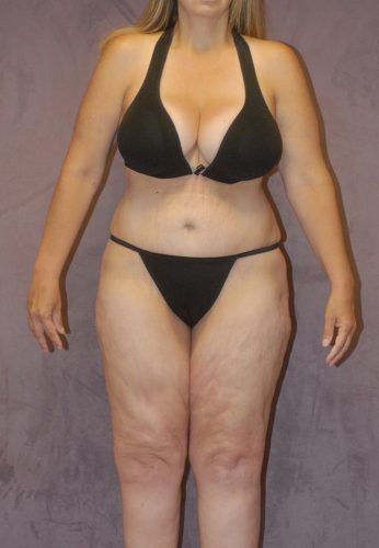 Liposuction Before & After