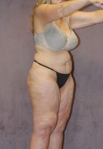 Liposuction Before & After