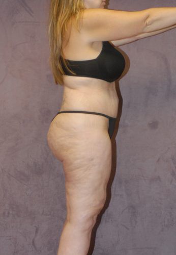 Liposuction Before & After