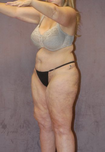 Liposuction Before & After