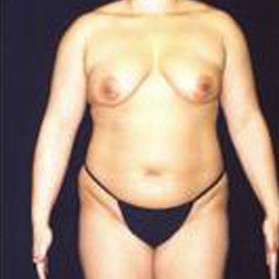 Liposuction Before & After