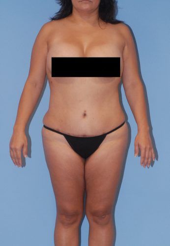Liposuction Before & After