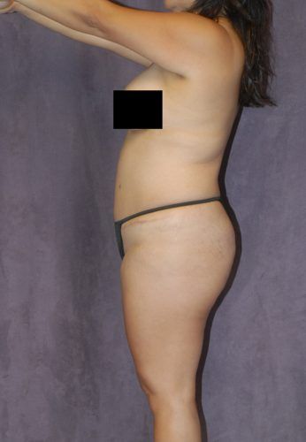 Liposuction Before & After