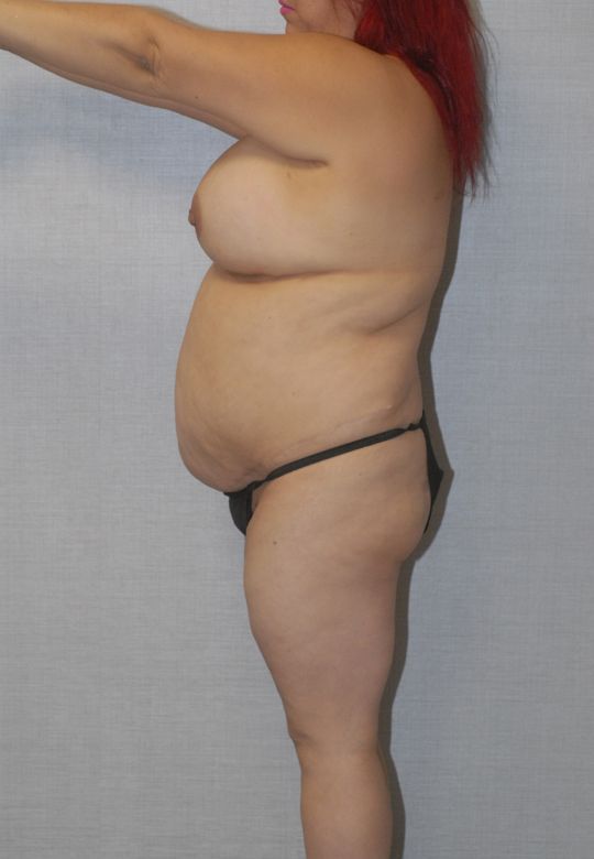 Liposuction Before & After