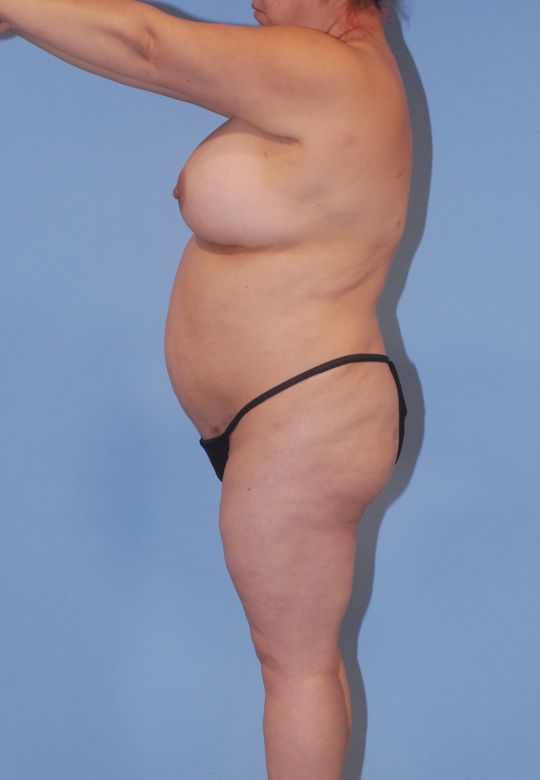 Liposuction Before & After