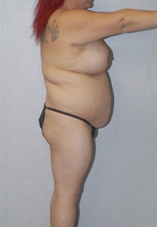 Liposuction Before & After